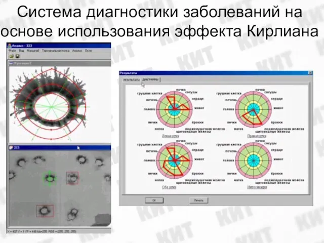 Система диагностики заболеваний на основе использования эффекта Кирлиана