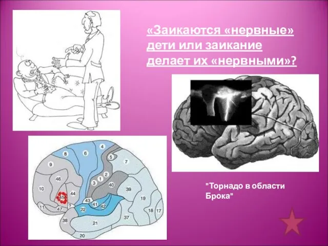 «Заикаются «нервные» дети или заикание делает их «нервными»? "Торнадо в области Брока"