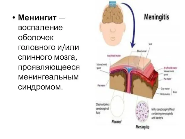 Менингит — воспаление оболочек головного и/или спинного мозга, проявляющееся менингеальным синдромом.