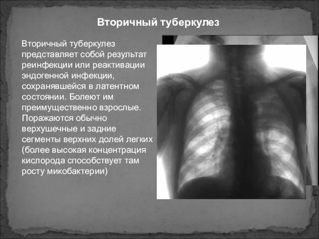 Вторичный туберкулез Вторичный туберкулез представляет собой результат реинфекции или реактивации эндогенной инфекции,
