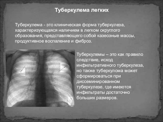 Туберкулема легких Туберкулема - это клиническая форма туберкулеза, характеризующаяся наличием в легком