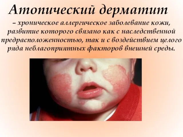 Атопический дерматит – хроническое аллергическое заболевание кожи, развитие которого связано как с