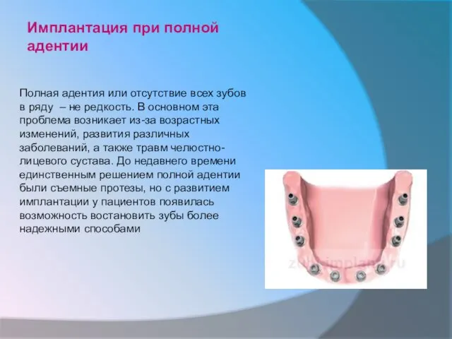 Имплантация при полной адентии Полная адентия или отсутствие всех зубов в ряду