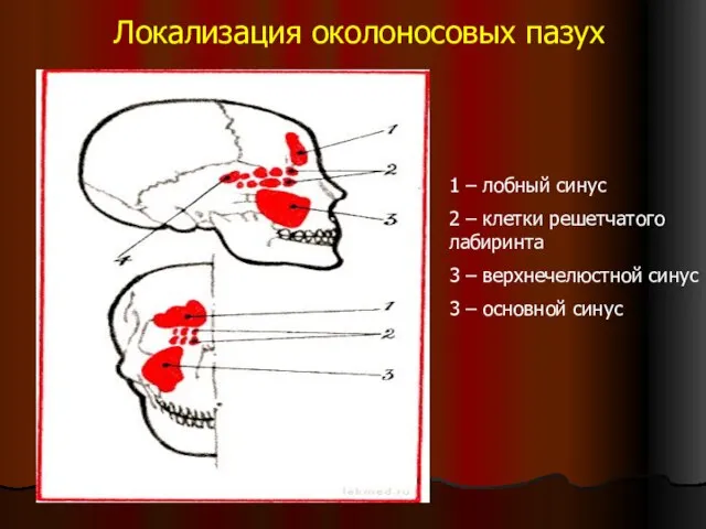 Локализация околоносовых пазух 1 – лобный синус 2 – клетки решетчатого лабиринта