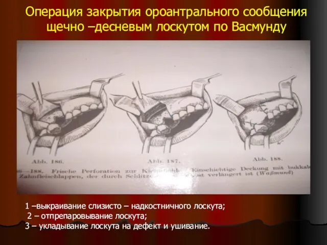 Операция закрытия ороантрального сообщения щечно –десневым лоскутом по Васмунду 1 –выкраивание слизисто