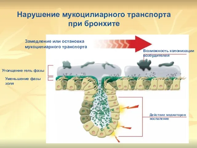 Нарушение мукоцилиарного транспорта при бронхите Утолщение гель фазы Уменьшение фазы золя Действие