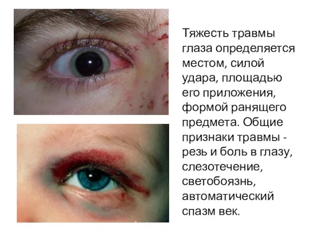 Тяжесть травмы глаза определяется местом, силой удара, площадью его приложения, формой ранящего