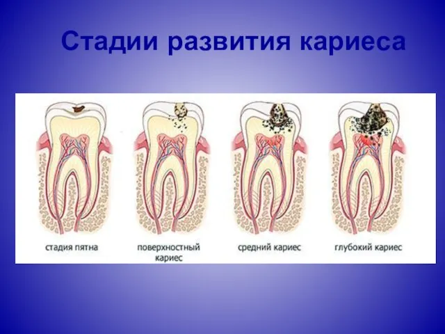 Стадии развития кариеса