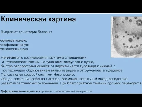 Клиническая картина Выделяют три стадии болезни: эритематозную, эксфолиативную регенеративную. Начинается с возникновения