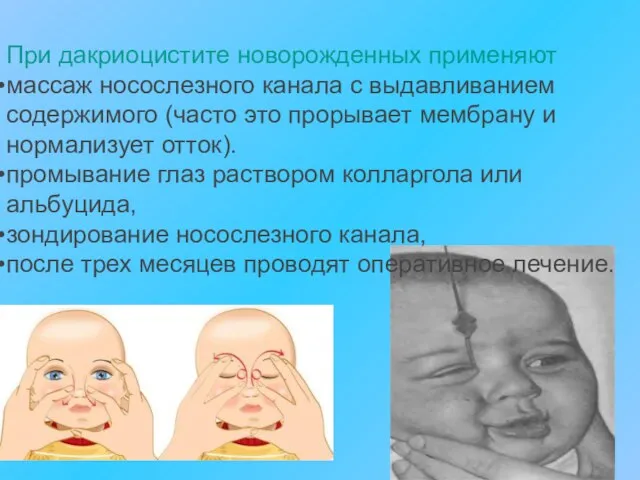 При дакриоцистите новорожденных применяют массаж носослезного канала с выдавливанием содержимого (часто это