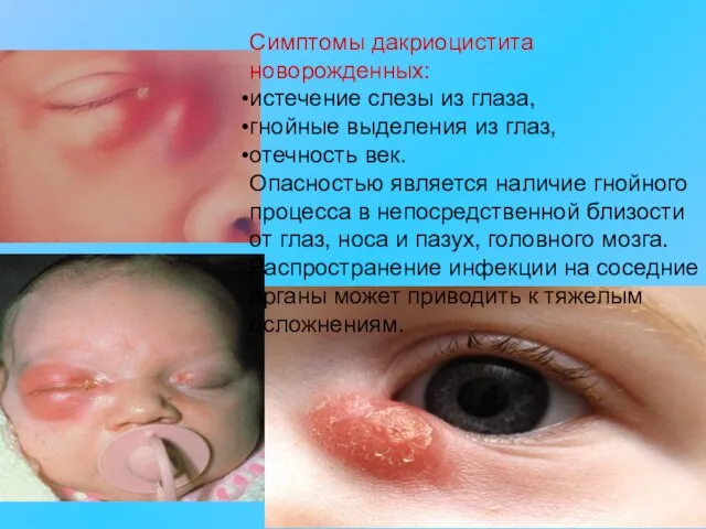 Симптомы дакриоцистита новорожденных: истечение слезы из глаза, гнойные выделения из глаз, отечность