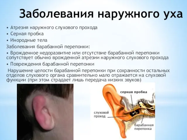 Заболевания наружного уха • Атрезия наружного слухового прохода • Серная пробка •