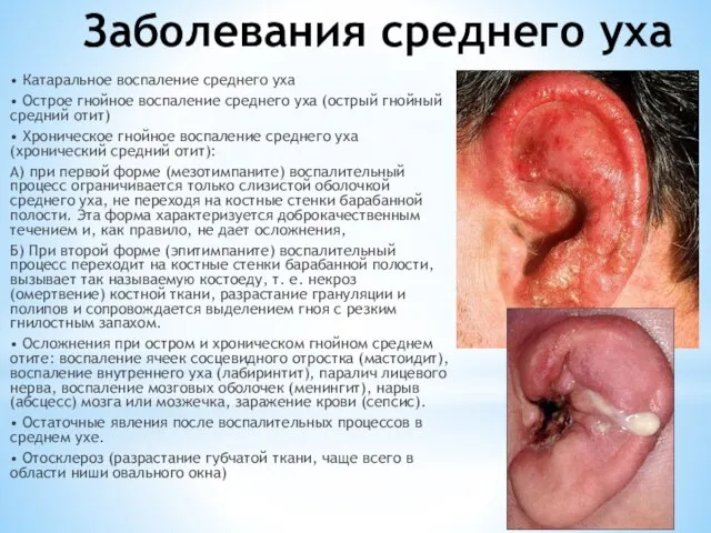 Заболевания среднего уха • Катаральное воспаление среднего уха • Острое гнойное воспаление