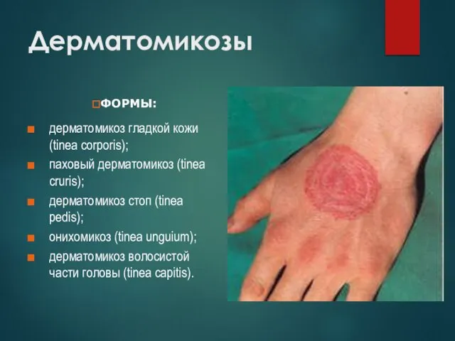 Дерматомикозы дерматомикоз гладкой кожи (tinea corporis); паховый дерматомикоз (tinea cruris); дерматомикоз стоп
