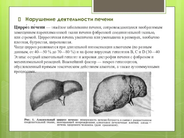 Нарушение деятельности печени Цирро́з пе́чени — тяжёлое заболевание печени, сопровождающееся необратимым замещением