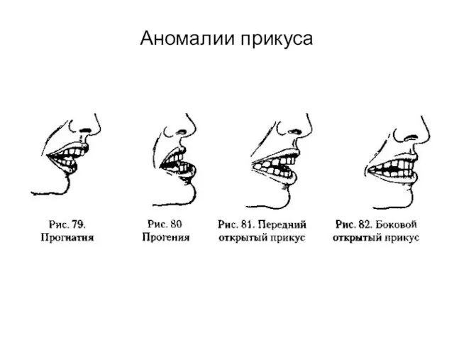 Аномалии прикуса