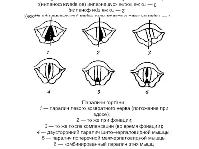 Параличи гортани: 1 — паралич левого возвратного нерва (положение при вдохе); 2