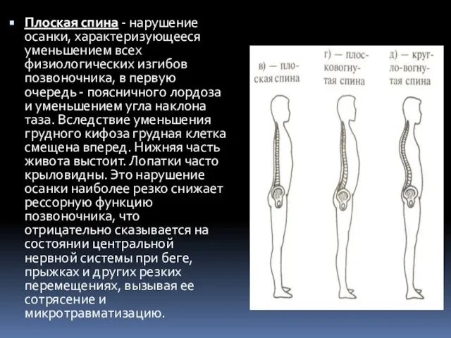 Плоская спина - нарушение осанки, характеризующееся уменьшением всех физиологических изгибов позвоночника, в