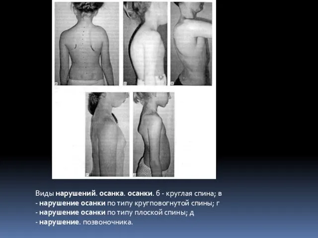 Виды нарушений. осанка. осанки. б - круглая спина; в - нарушение осанки