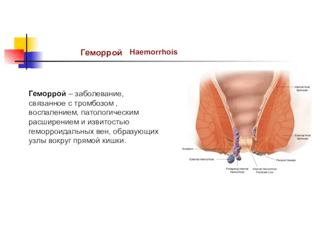 Геморрой Haemorrhois Геморрой – заболевание, связанное с тромбозом , воспалением, патологическим расширением