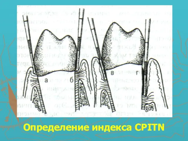 Определение индекса CPITN