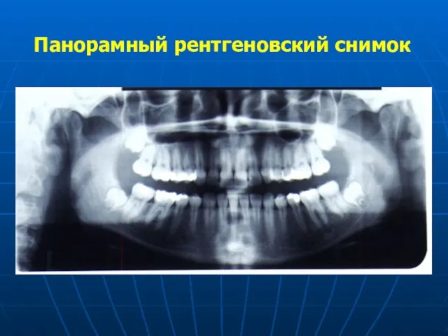 Панорамный рентгеновский снимок