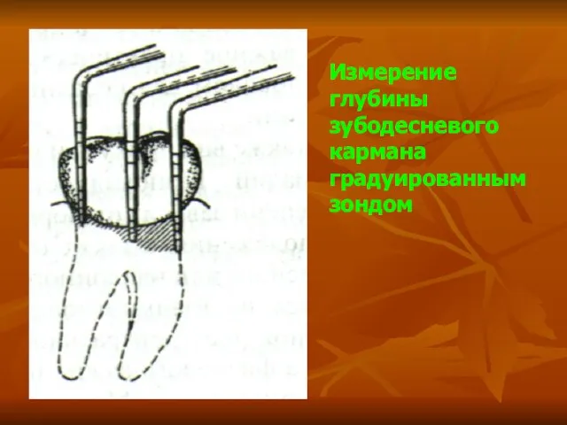 Измерение глубины зубодесневого кармана градуированным зондом