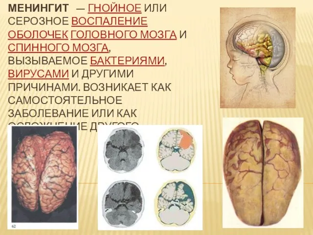 Менингит — гнойное или серозное воспаление оболочек головного мозга и спинного мозга,