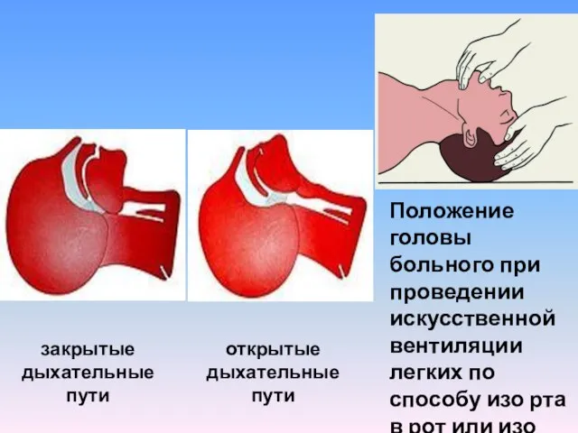 закрытые дыхательные пути открытые дыхательные пути Положение головы больного при проведении искусственной