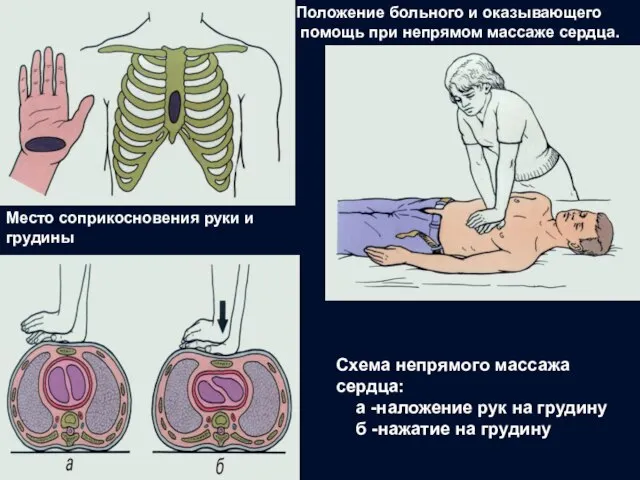 Место соприкосновения руки и грудины Положение больного и оказывающего помощь при непрямом