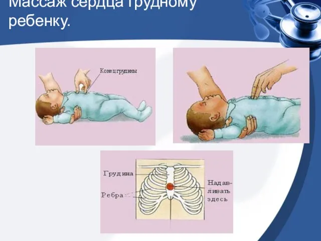 Массаж сердца грудному ребенку.