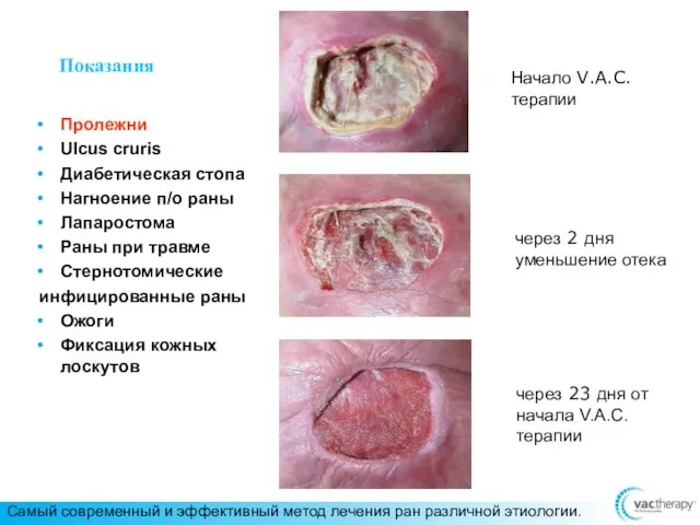 Показания Пролежни Ulcus cruris Диабетическая стопа Нагноение п/о раны Лапаростома Раны при