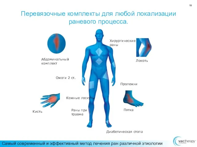 Перевязочные комплекты для любой локализации раневого процесса. Диабетическая стопа Пролежни Хирургические раны