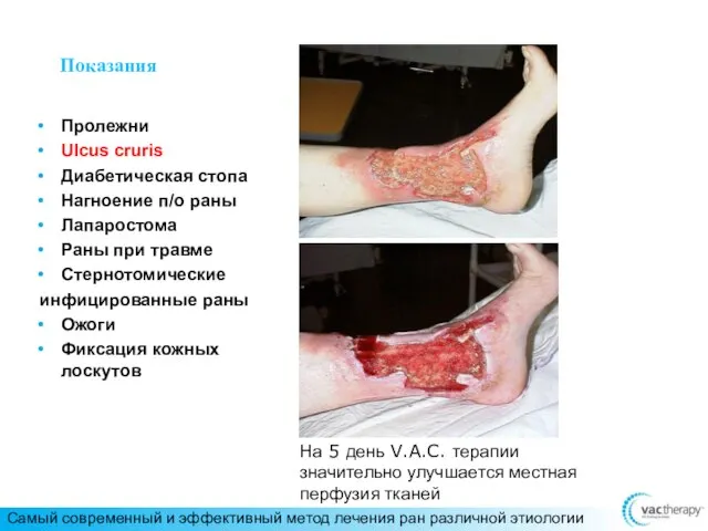 Пролежни Ulcus cruris Диабетическая стопа Нагноение п/о раны Лапаростома Раны при травме