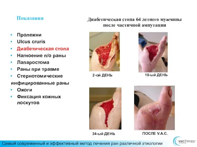 Показания Пролежни Ulcus cruris Диабетическая стопа Нагноение п/о раны Лапаростома Раны при