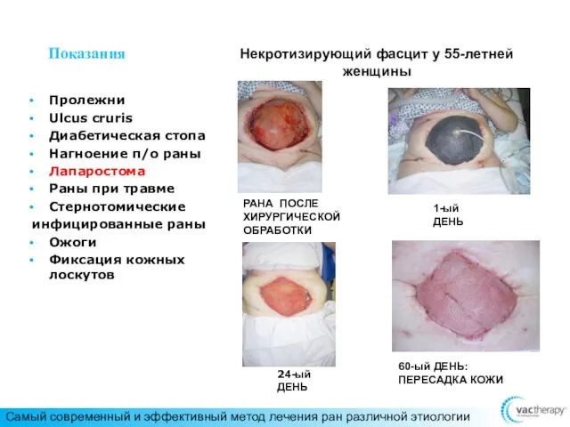 Некротизирующий фасцит у 55-летней женщины Показания Пролежни Ulcus cruris Диабетическая стопа Нагноение