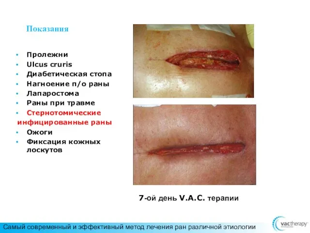 Показания Пролежни Ulcus cruris Диабетическая стопа Нагноение п/о раны Лапаростома Раны при