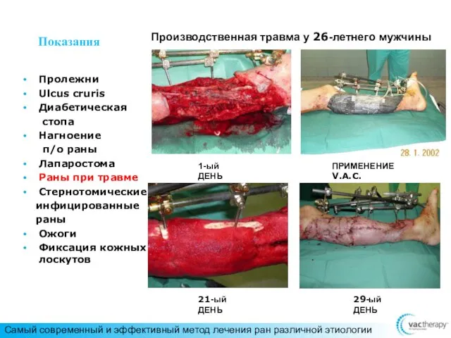 Показания Пролежни Ulcus cruris Диабетическая стопа Нагноение п/о раны Лапаростома Раны при