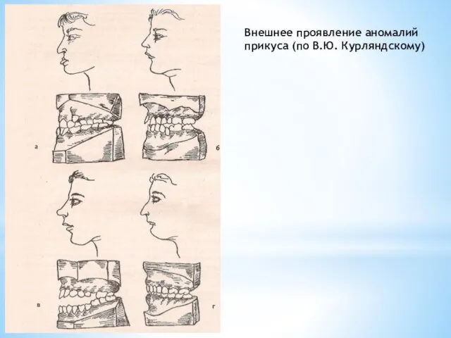 Внешнее проявление аномалий прикуса (по В.Ю. Курляндскому)