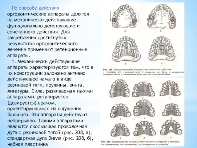 По способу действия ортодонтические аппараты делятся на механически действующие, функционально действующие и