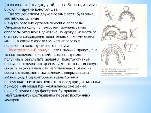 (оттягивающей кзади) дугой, каппа Бынина, аппарат Врюкля и другие конструкции. Так же