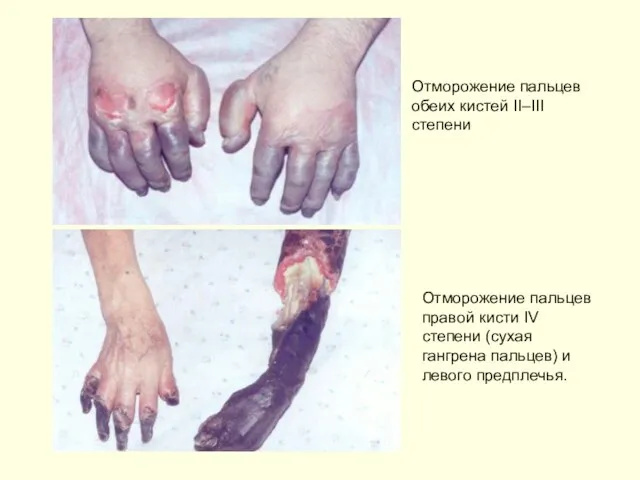 Отморожение пальцев обеих кистей II–III степени Отморожение пальцев правой кисти IV степени