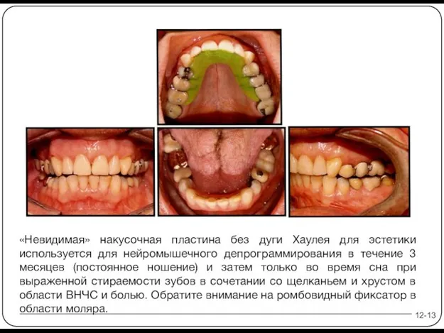 «Невидимая» накусочная пластина без дуги Хаулея для эстетики используется для нейромышечного депрограммирования