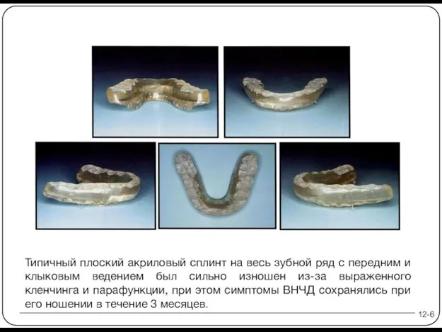 12-6 Типичный плоский акриловый сплинт на весь зубной ряд с передним и