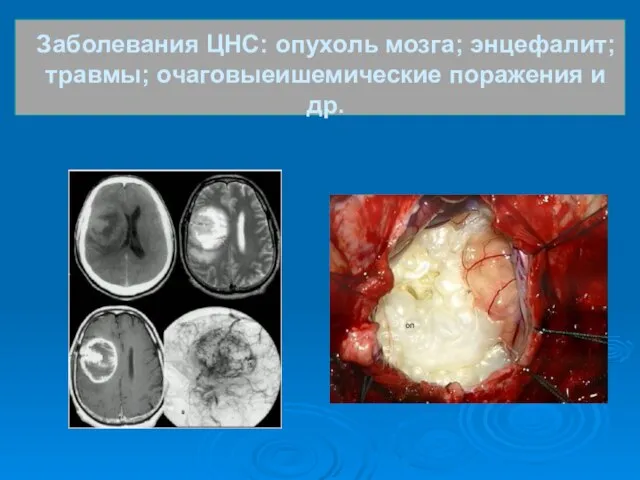 Заболевания ЦНС: опухоль мозга; энцефалит; травмы; очаговыеишемические поражения и др.