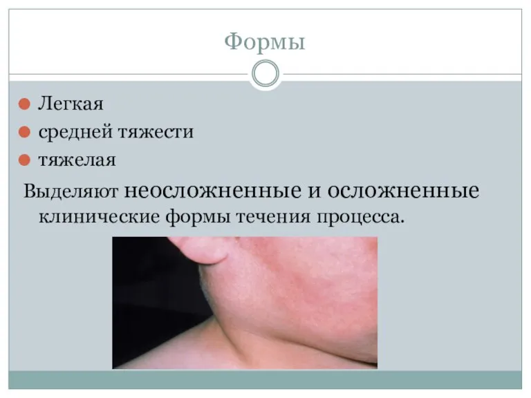 Формы Легкая средней тяжести тяжелая Выделяют неосложненные и осложненные клинические формы течения процесса.