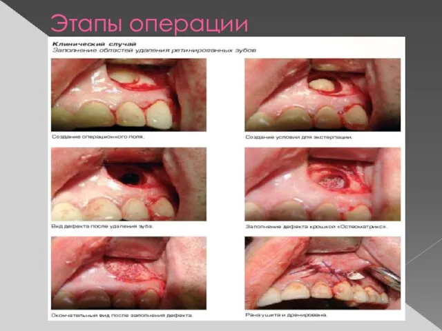 Этапы операции