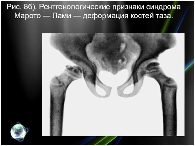 Рис. 8б). Рентгенологические признаки синдрома Марото — Лами — деформация костей таза.