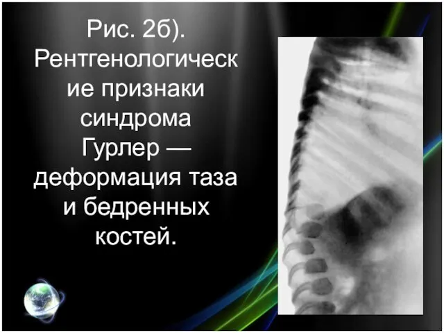 Рис. 2б). Рентгенологические признаки синдрома Гурлер — деформация таза и бедренных костей.