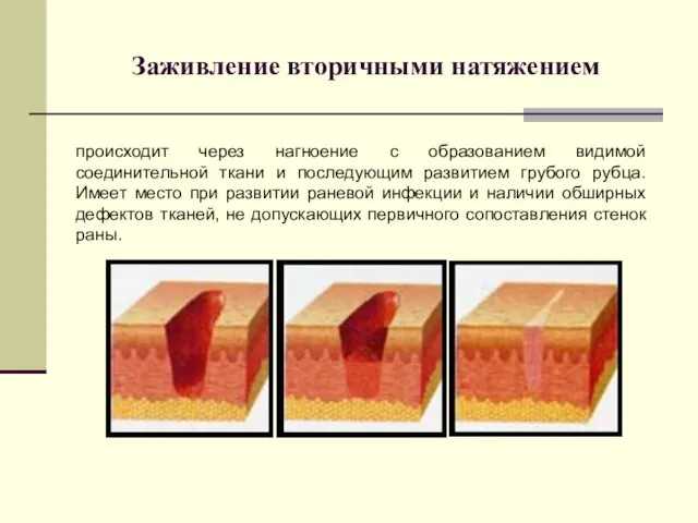 Заживление вторичными натяжением происходит через нагноение с образованием видимой соединительной ткани и